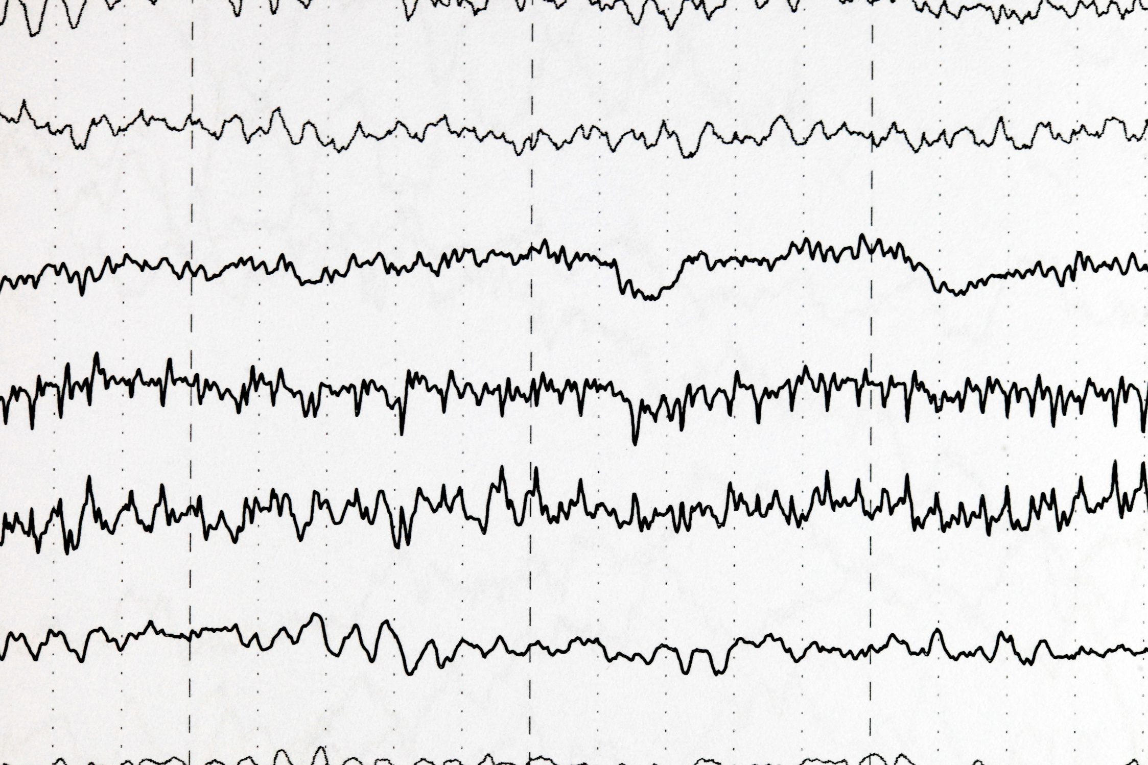 Brain wave patterns on electroencephalogram, EEG of the pediatric patients, problems in the electrical activity of the brain.